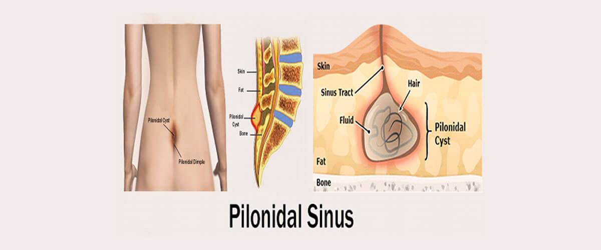 The endoscopic treatment of pilonidal sinus disease a shortterm  caseseries study  Annals of Saudi Medicine